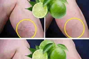 Poboljšanje protoka krvi Limun sadrži spojeve poput citrina koji poboljšavaju mikrocirkulaciju. Redovna upotreba limuna pomaže u razrjeđivanju nakupljene krvi u venama, čime se smanjuje pritisak i neugodan osjećaj “teških nogu” na kraju dana. Noćni ritual za lakši korak: Kako koristiti limun? Da biste osjetili prave efekte, stručnjaci za prirodnu medicinu preporučuju primjenu limuna neposredno prije spavanja. Tokom noći, dok vaše tijelo miruje, ljekoviti sastojci imaju priliku da prodru dublje i podstaknu regeneraciju tkiva. Recept za masažu s limunom i maslinovim uljem Iscijedite sok od jednog svježeg limuna. Pomiješajte ga s dvije kašike ekstra djevičanskog maslinovog ulja. Nježno umasirajte mješavinu na područja zahvaćena venama, uvijek pokretima od članaka prema gore, u smjeru srca. Ostavite da djeluje preko noći kako bi koža i vene upile hranjive materije. Ovaj postupak ne samo da pomaže venama, već i dubinski hidrira kožu, čineći je mekšom i zdravijom. Realna očekivanja i preventivni koraci Važno je razumjeti da limun ne može hirurški “izbrisati” već postojeće, jako oštećene vene u jednom danu. Međutim, redovna primjena ovog noćnog rituala može drastično smanjiti otok, bol i vidljivost kapilara. Za najbolje rezultate, kombinujte ovaj prirodni tretman s laganom šetnjom i izbjegavanjem predugog stajanja ili sjedenja.