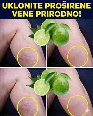 Poboljšanje protoka krvi Limun sadrži spojeve poput citrina koji poboljšavaju mikrocirkulaciju. Redovna upotreba limuna pomaže u razrjeđivanju nakupljene krvi u venama, čime se smanjuje pritisak i neugodan osjećaj “teških nogu” na kraju dana. Noćni ritual za lakši korak: Kako koristiti limun? Da biste osjetili prave efekte, stručnjaci za prirodnu medicinu preporučuju primjenu limuna neposredno prije spavanja. Tokom noći, dok vaše tijelo miruje, ljekoviti sastojci imaju priliku da prodru dublje i podstaknu regeneraciju tkiva. Recept za masažu s limunom i maslinovim uljem Iscijedite sok od jednog svježeg limuna. Pomiješajte ga s dvije kašike ekstra djevičanskog maslinovog ulja. Nježno umasirajte mješavinu na područja zahvaćena venama, uvijek pokretima od članaka prema gore, u smjeru srca. Ostavite da djeluje preko noći kako bi koža i vene upile hranjive materije. Ovaj postupak ne samo da pomaže venama, već i dubinski hidrira kožu, čineći je mekšom i zdravijom. Realna očekivanja i preventivni koraci Važno je razumjeti da limun ne može hirurški “izbrisati” već postojeće, jako oštećene vene u jednom danu. Međutim, redovna primjena ovog noćnog rituala može drastično smanjiti otok, bol i vidljivost kapilara. Za najbolje rezultate, kombinujte ovaj prirodni tretman s laganom šetnjom i izbjegavanjem predugog stajanja ili sjedenja.